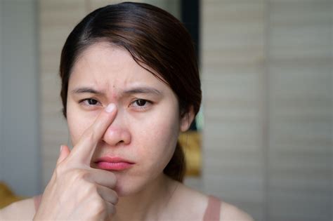 rumahjitu|Jerawat di Alis, Ini 6 Penyebab dan Cara Jitu Mengatasinya.